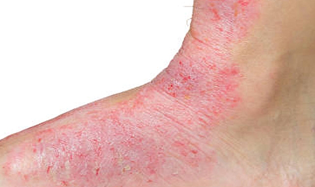 Kelebek hastalığı (Lupus) Nedir?