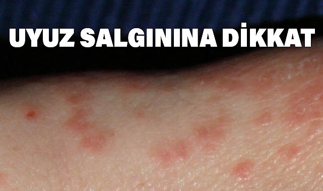 Uyuz Salgınına Dikkat! Uyuz Nasıl Bulaşır?