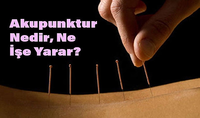 Akupunktur Nedir, Ne İşe Yarar?