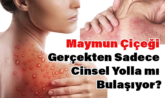 Maymun Çiçeği Virüsü Sadece Cinsel Yolla mı Bulaşıyor? Gerçekler Endişe Verici!