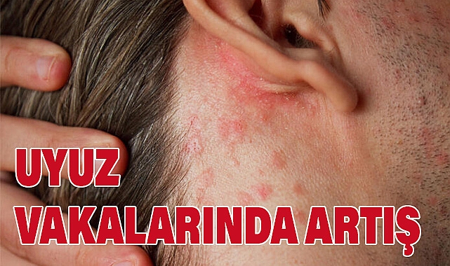 Uyuz Vakalarında Hızlı Artış