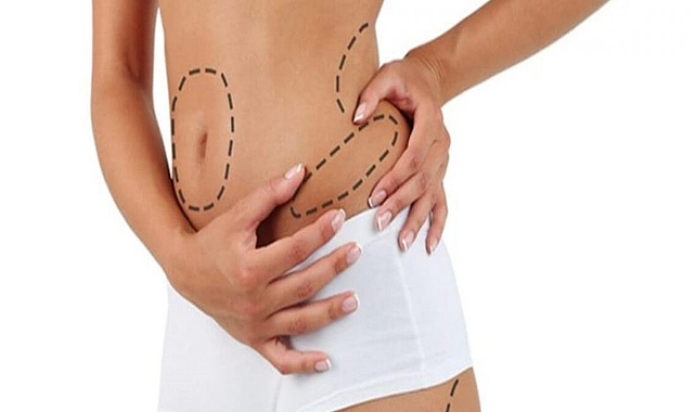 Liposuction Ameliyatı Hakkında Bilinmesi Gerekenler
