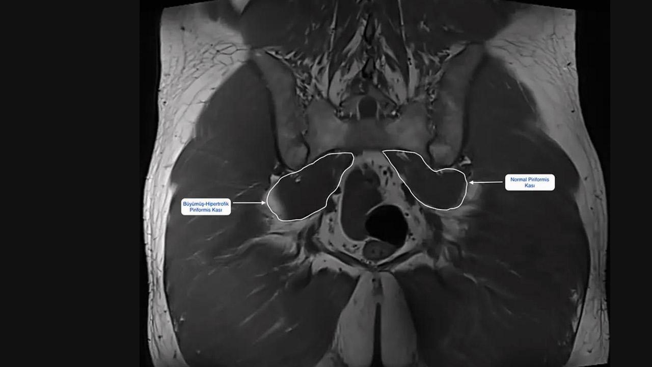 Piriformis Sendromu: Bel Fıtığı Sanılıp Gözden Kaçan Kalça ve Bacak Ağrısı