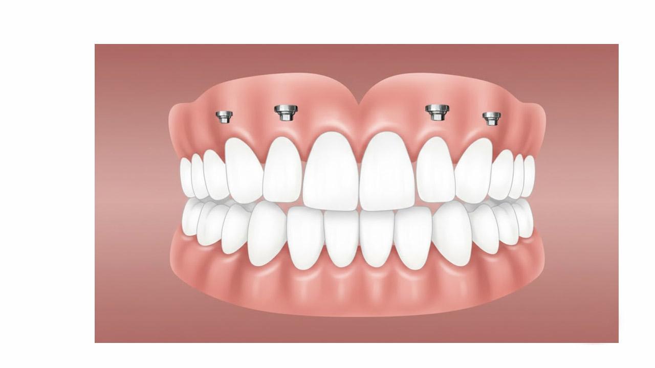 Hollywood Smile ile Estetik ve Özgüvenin Yeni Tanımı