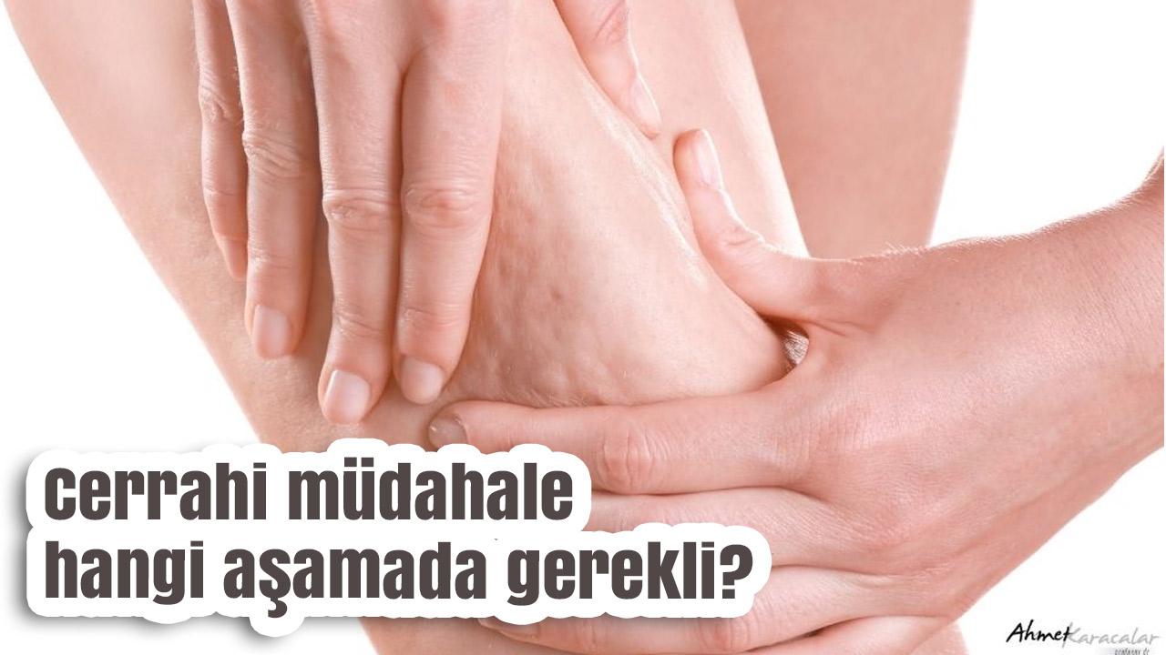 Prof. Dr. Ahmet Karacalar: Selülit Sadece Estetik Değil, Metabolik Bir Sorundur