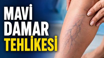 Bacaklardaki Belirgin Mavi Damarlar Hastalık Habercisi Olabilir